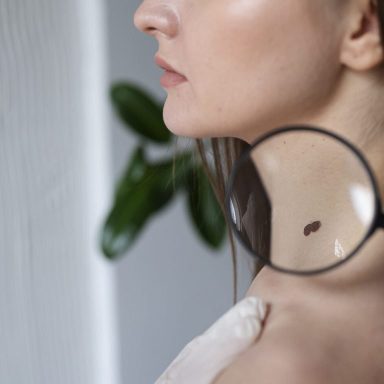 Skin tag mole removal